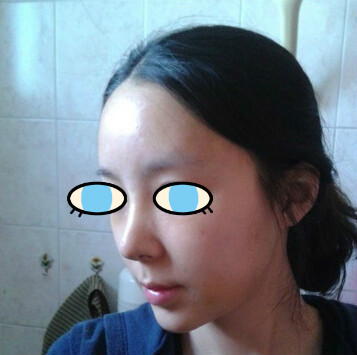 做了膨體隆鼻我也有了高鼻梁 **