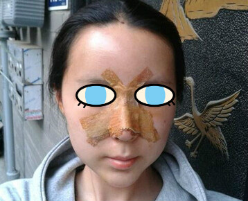 做了膨體隆鼻我也有了高鼻梁 **