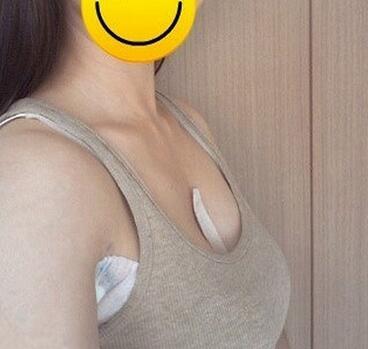 北京世熙自體脂肪隆胸2個(gè)月啦~