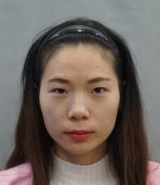 長沙美之峰重瞼+開眼角恢復(fù)過程圖