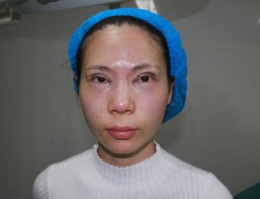 長沙美之峰重瞼+開眼角恢復(fù)過程圖