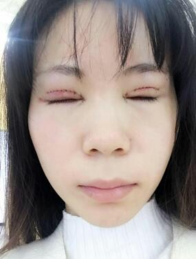 長沙美之峰重瞼+開眼角恢復(fù)過程圖