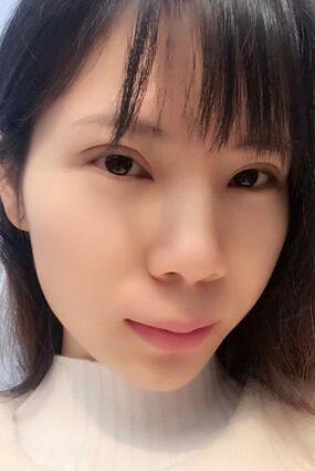 長沙美之峰重瞼+開眼角恢復(fù)過程圖