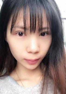 長沙美之峰重瞼+開眼角恢復(fù)過程圖