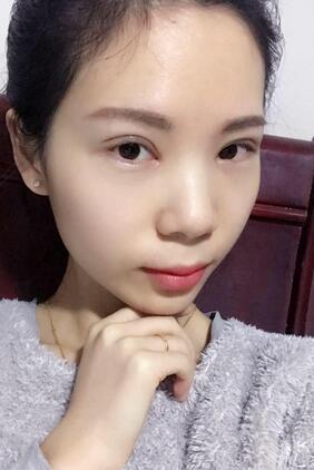長沙美之峰重瞼+開眼角恢復(fù)過程圖