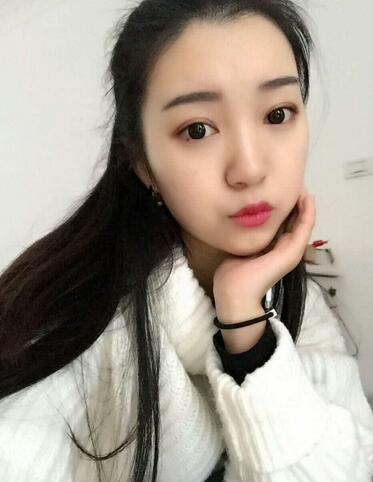 長(zhǎng)沙美之峰割雙眼皮3個(gè)月了