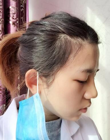 長(zhǎng)沙美之峰假體隆鼻恢復(fù)日記