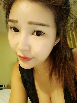 長沙美之峰隆鼻整形手術(shù)恢復日記圖