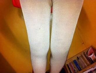 吸脂瘦大腿讓我夏天放肆(｡･∀･)ﾉﾞ嗨