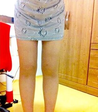 吸脂瘦大腿讓我夏天放肆(｡･∀･)ﾉﾞ嗨