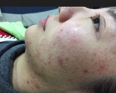 北京歐華去痘坑痘印兩個(gè)月