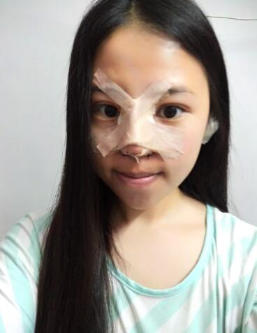 隆鼻整形真實恢復(fù)期圖片 隆鼻整形一個月了