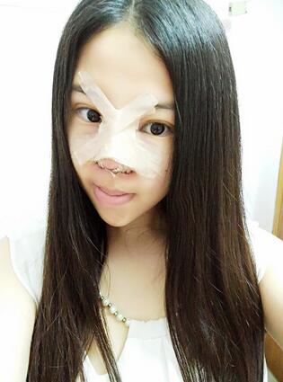 隆鼻整形真實恢復(fù)期圖片 隆鼻整形一個月了