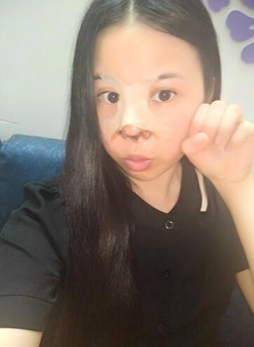隆鼻整形真實恢復(fù)期圖片 隆鼻整形一個月了