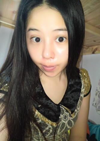 隆鼻整形真實恢復(fù)期圖片 隆鼻整形一個月了