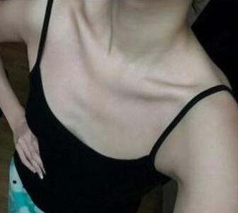 鄭州悅美假體隆胸2個月 果自然