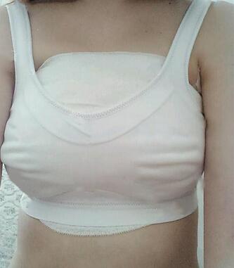 鄭州悅美假體隆胸2個月 果自然