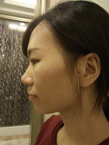隆鼻整形術(shù)后1-7天的照片 隆鼻整形經(jīng)歷分享