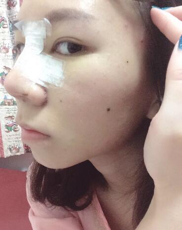隆鼻整形術(shù)后1-7天的照片 隆鼻整形經(jīng)歷分享
