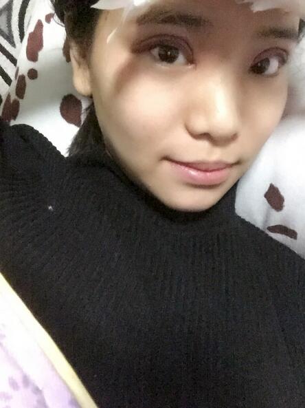 鄭州悅美切開雙眼皮半個(gè)月恢復(fù)日記