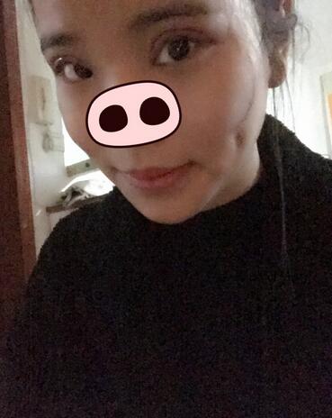 鄭州悅美切開雙眼皮半個(gè)月恢復(fù)日記