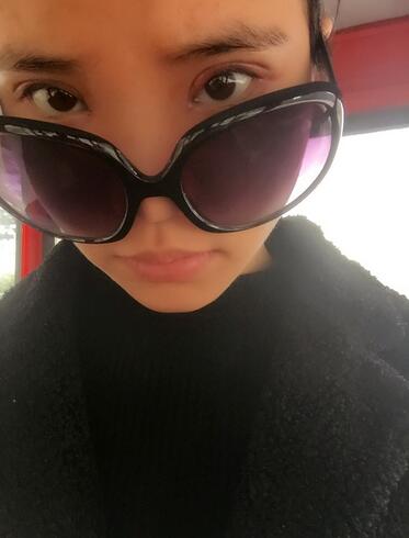 鄭州悅美切開雙眼皮半個(gè)月恢復(fù)日記