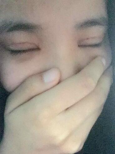 鄭州悅美切開雙眼皮半個(gè)月恢復(fù)日記