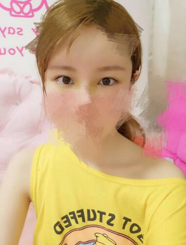 鄭州悅美微創(chuàng)雙眼皮+開(kāi)眼角3個(gè)月