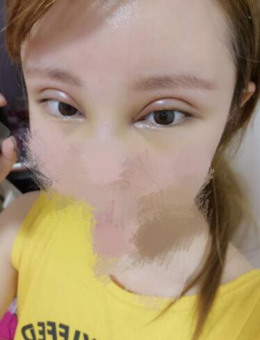 鄭州悅美微創(chuàng)雙眼皮+開(kāi)眼角3個(gè)月