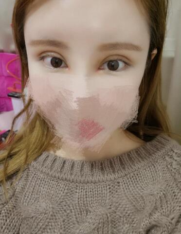 鄭州悅美微創(chuàng)雙眼皮+開(kāi)眼角3個(gè)月