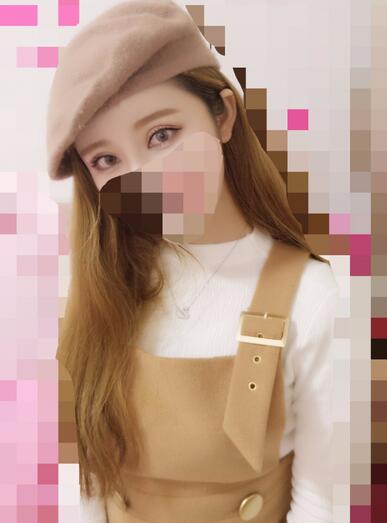 鄭州悅美微創(chuàng)雙眼皮+開(kāi)眼角3個(gè)月