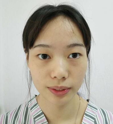 深圳晨曦三點(diǎn)定位雙眼皮日記