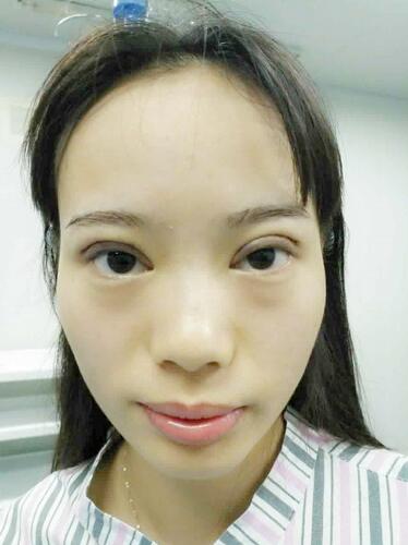 深圳晨曦三點(diǎn)定位雙眼皮日記