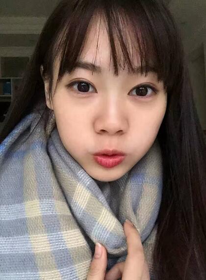 深圳晨曦三點(diǎn)定位雙眼皮日記