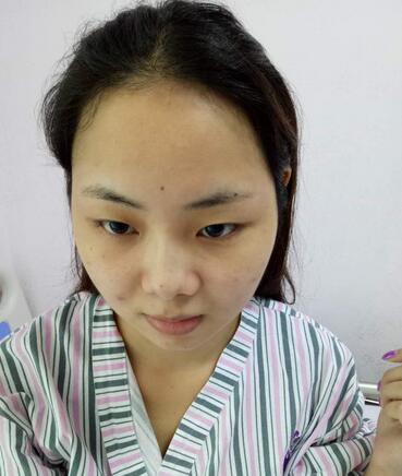 深圳晨曦隆鼻整形半年了 看看果