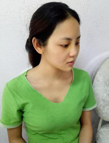 深圳晨曦隆鼻整形半年了 看看果