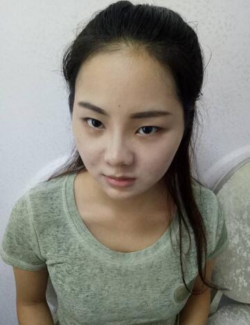 深圳晨曦隆鼻整形半年了 看看果