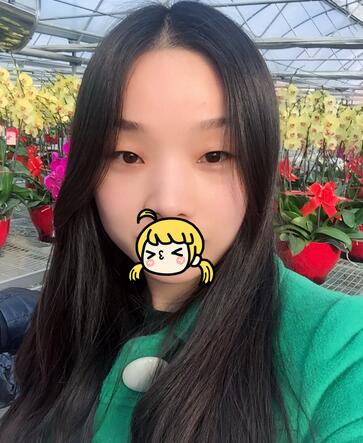 全切雙眼皮1個月過程圖