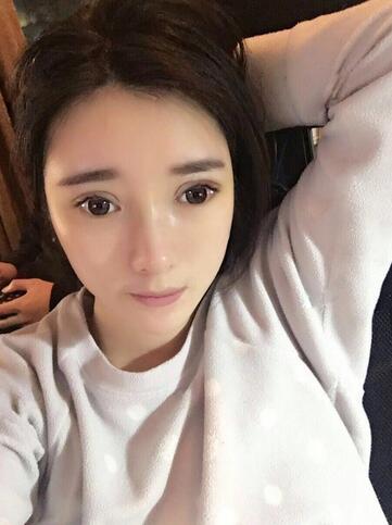 雙眼皮修復(fù)+自體脂肪填充恢復(fù)日記