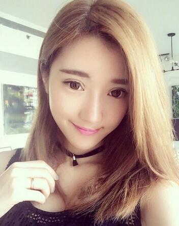 雙眼皮修復(fù)+自體脂肪填充恢復(fù)日記