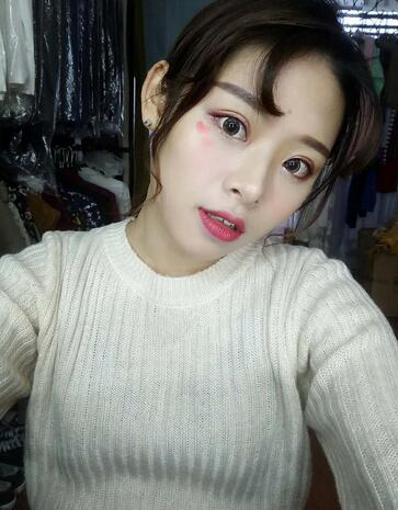 北京熙朵全切雙眼皮1個(gè)月恢復(fù)日記