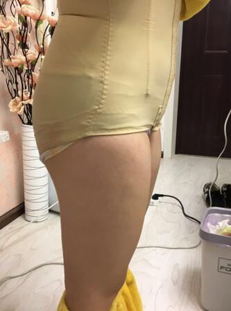 腰腹部吸脂后一個(gè)月照片