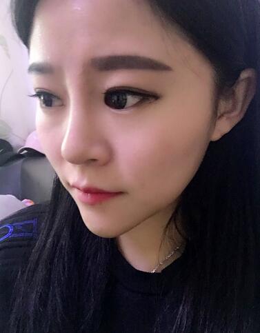 玻尿酸隆鼻恢復(fù)過程圖