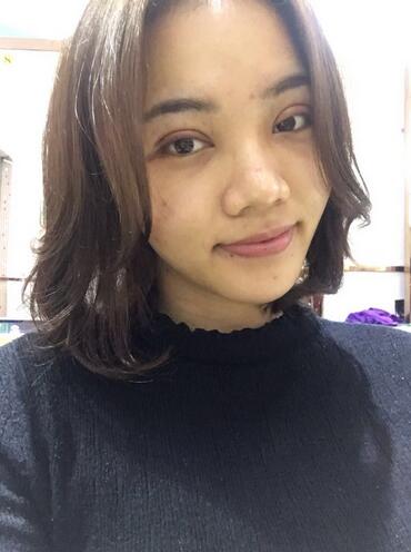 全切雙眼皮恢復(fù)1個(gè)月過(guò)程圖