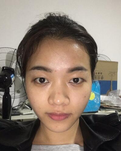 全切雙眼皮恢復(fù)1個(gè)月過(guò)程圖