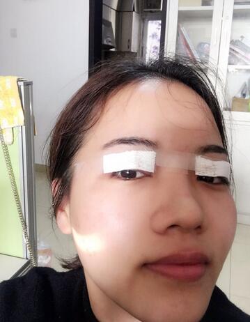 全切雙眼皮恢復(fù)1個(gè)月過(guò)程圖