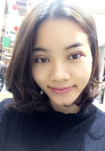 全切雙眼皮恢復(fù)1個(gè)月過(guò)程圖