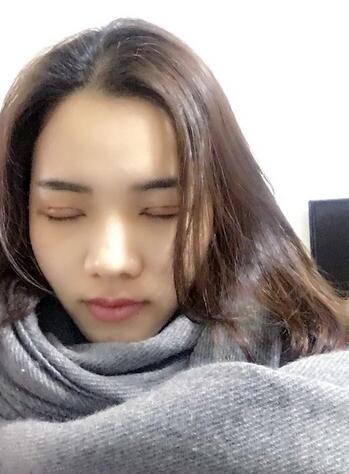 全切雙眼皮恢復(fù)1個(gè)月過(guò)程圖