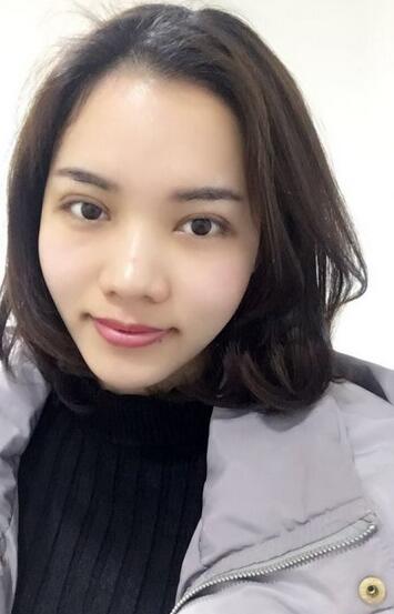 全切雙眼皮恢復(fù)1個(gè)月過(guò)程圖