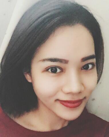 全切雙眼皮恢復(fù)1個(gè)月過(guò)程圖